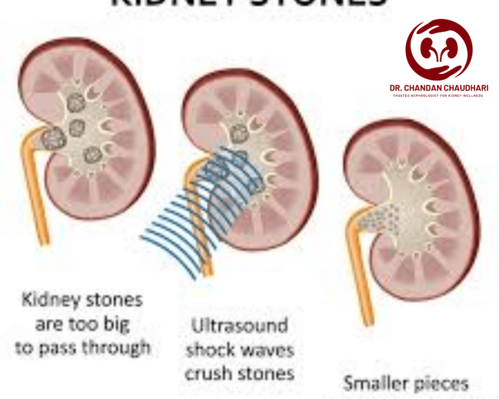 kidney-stone-treatment-in-mumbai-by-an-expert-kidney-specialist