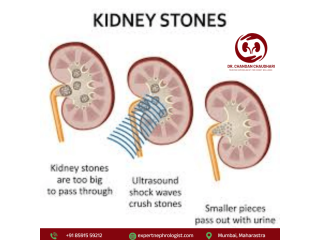 kidney-stone-treatment-in-mumbai-by-an-expert-kidney-specialist-small-0