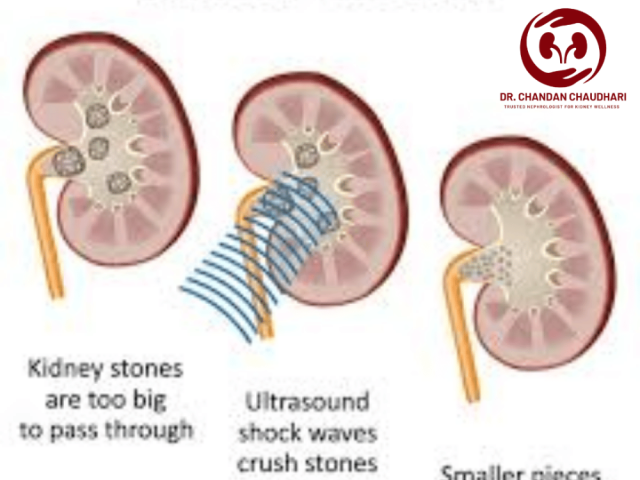 kidney-stone-treatment-in-mumbai-by-an-expert-kidney-specialist