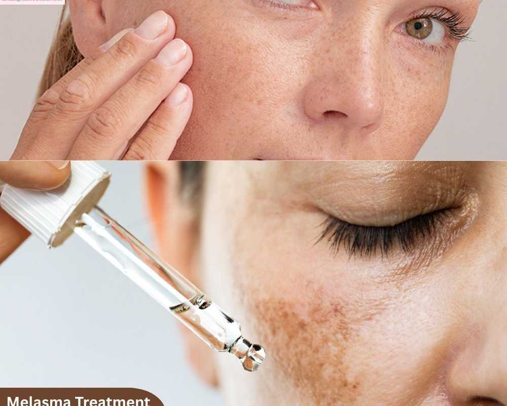 best-melasma-treatment-solutions-in-vasant-kunj