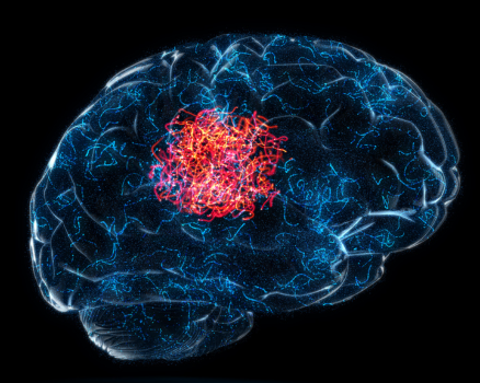 expert-surgical-support-for-complex-brain-tumor-conditions