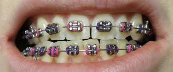 get-a-confident-smile-with-best-dental-brace-in-chetla-big-0