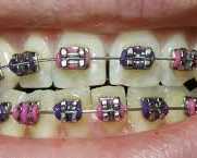 get-a-confident-smile-with-best-dental-brace-in-chetla