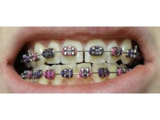 get-a-confident-smile-with-best-dental-brace-in-chetla-small-0