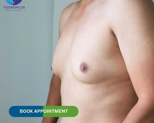 male-chest-surgery-gynecomastia-correction-in-ahmedabad