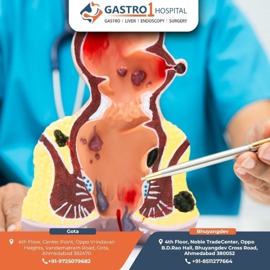 best-fissure-doctor-in-ahmedabad-gastro1-hospital-big-0