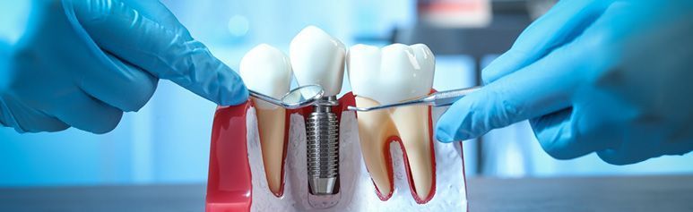 best-dental-implants-treatment-in-faridabad-big-0