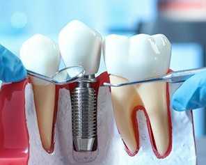 best-dental-implants-treatment-in-faridabad