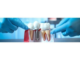 best-dental-implants-treatment-in-faridabad-small-0