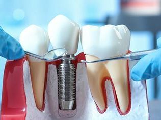 best-dental-implants-treatment-in-faridabad