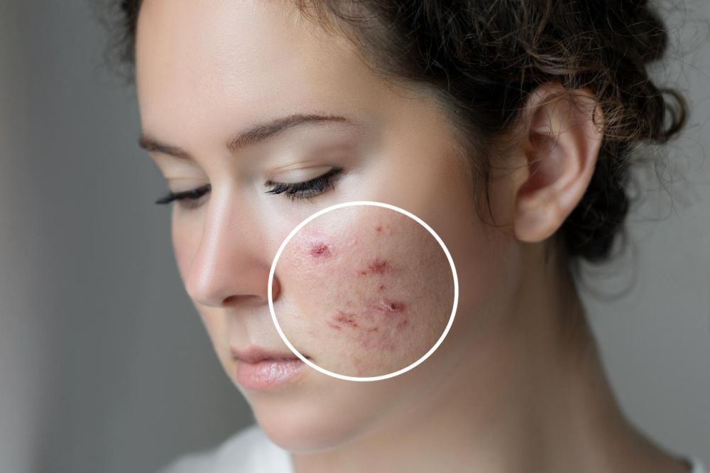 best-acne-scar-treatment-in-noida-by-expert-dermatologists-big-0