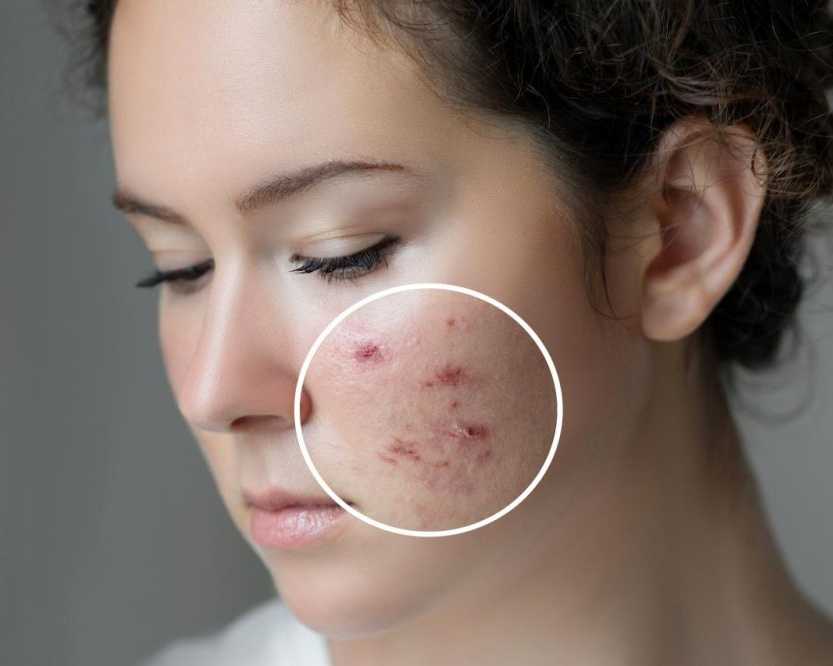 best-acne-scar-treatment-in-noida-by-expert-dermatologists
