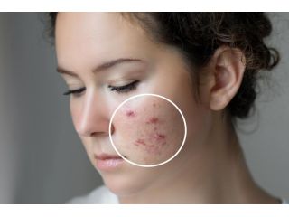 best-acne-scar-treatment-in-noida-by-expert-dermatologists-small-0