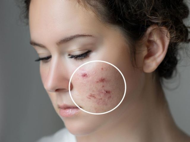 best-acne-scar-treatment-in-noida-by-expert-dermatologists