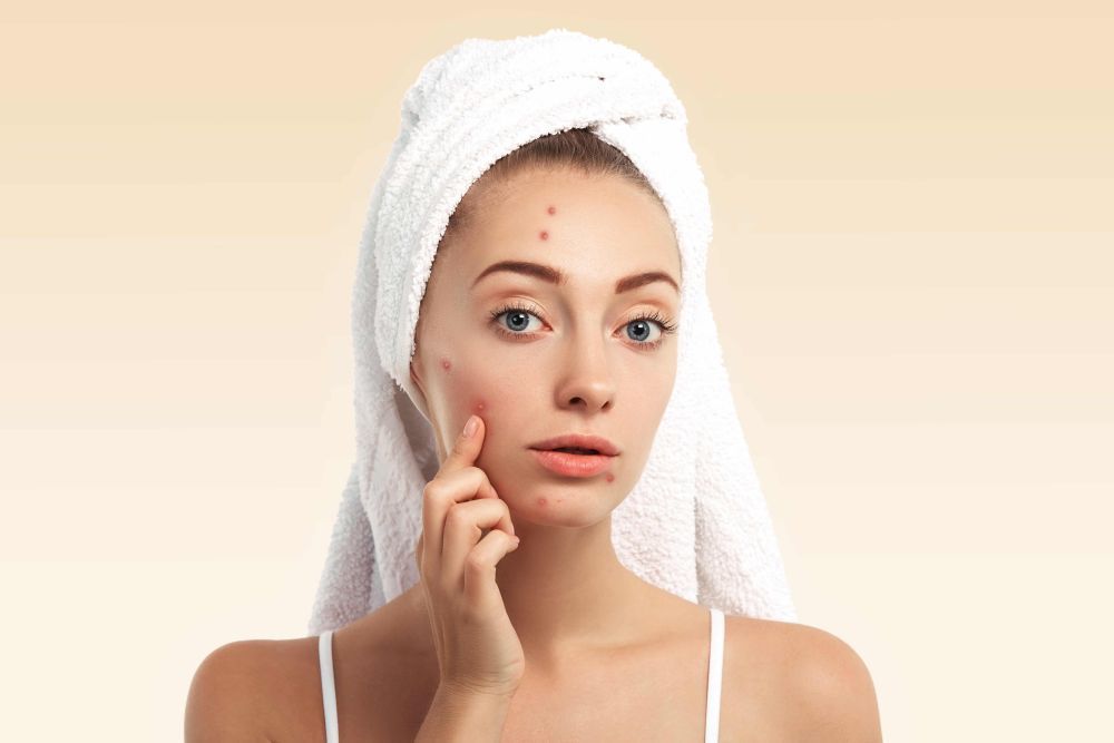 summer-skincare-tips-for-acne-prone-skin-big-0