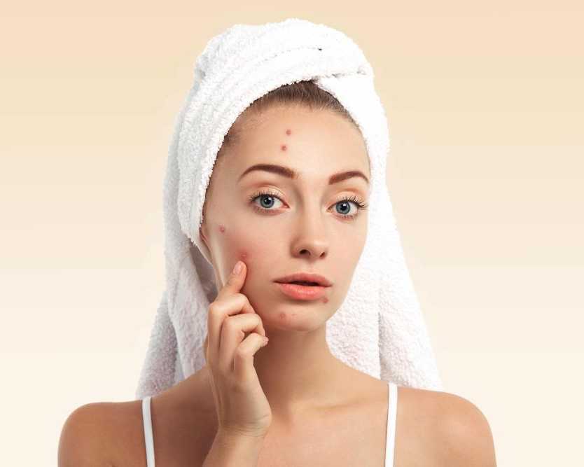 summer-skincare-tips-for-acne-prone-skin