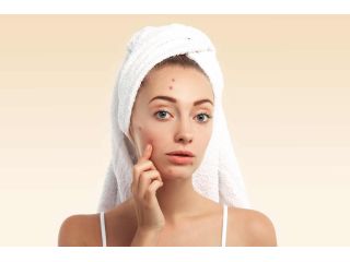summer-skincare-tips-for-acne-prone-skin-small-0