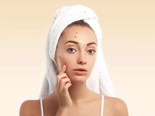 summer-skincare-tips-for-acne-prone-skin