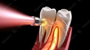 advanced-root-canal-treatment-in-chetla-for-healthy-teeth-big-0
