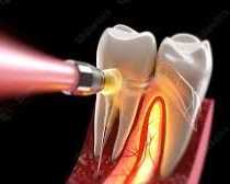 advanced-root-canal-treatment-in-chetla-for-healthy-teeth