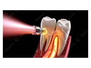 advanced-root-canal-treatment-in-chetla-for-healthy-teeth-small-0