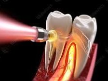 advanced-root-canal-treatment-in-chetla-for-healthy-teeth