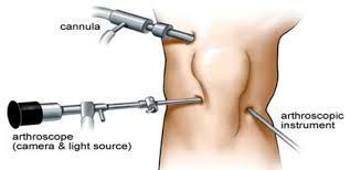 knee-arthroscopy-treatment-in-ahmedabad-signs-benefits-big-0