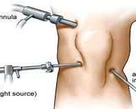 knee-arthroscopy-treatment-in-ahmedabad-signs-benefits