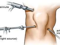 knee-arthroscopy-treatment-in-ahmedabad-signs-benefits