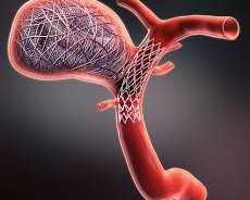 aneurysm-coiling-modern-care-faster-recovery-better-outcomes