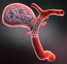 aneurysm-coiling-modern-care-faster-recovery-better-outcomes-big-0