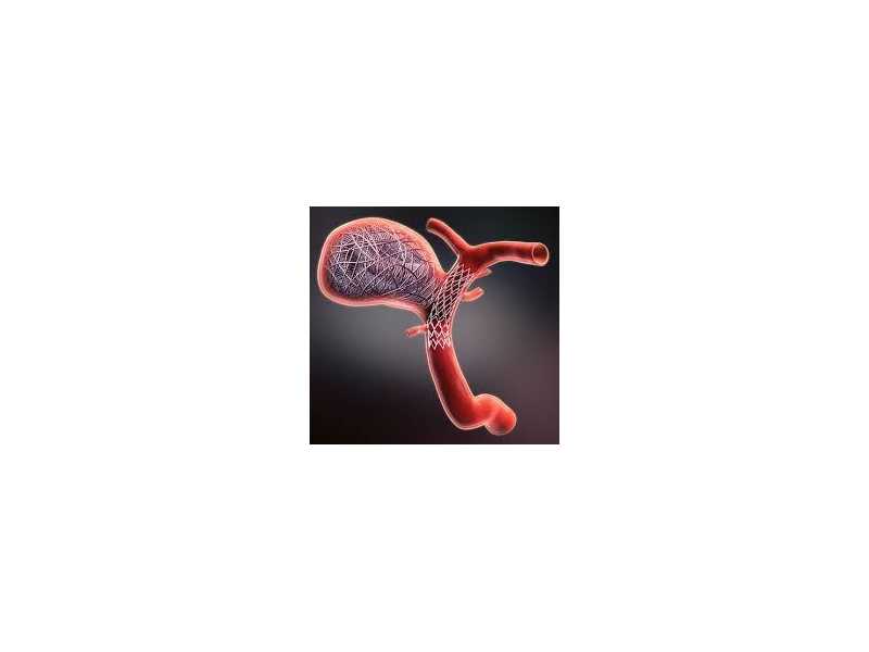 aneurysm-coiling-modern-care-faster-recovery-better-outcomes-small-0