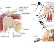 shoulder-arthroscopy-for-shoulder-injuries-in-ahmedabad