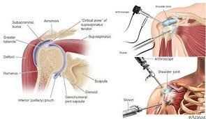 shoulder-arthroscopy-for-shoulder-injuries-in-ahmedabad-big-0