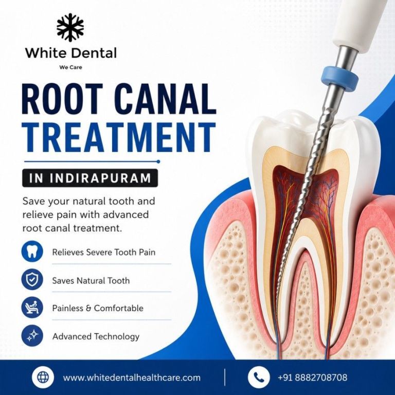 root-canal-treatment-in-indirapuram-big-0