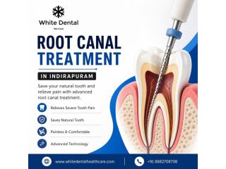 root-canal-treatment-in-indirapuram-small-0