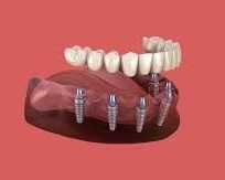 trusted-dental-implant-solutions-in-chetla