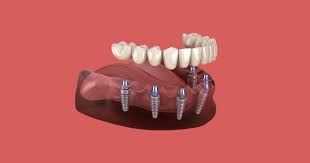 trusted-dental-implant-solutions-in-chetla-big-0