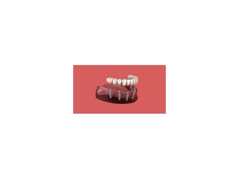 trusted-dental-implant-solutions-in-chetla-small-0