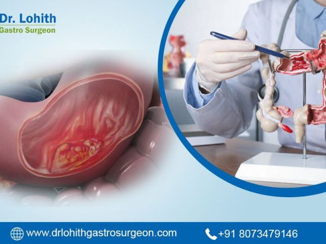 best-gastrointestinal-oncology-surgery-in-bangalore