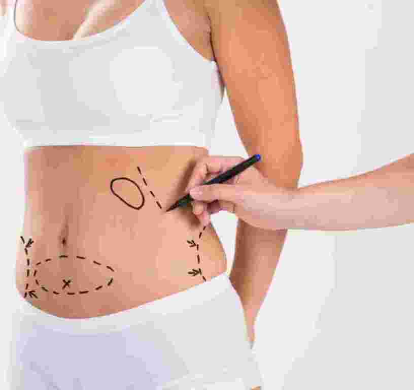 liposuction-surgery-in-andheri-remove-stubborn-fat-effectively-big-0