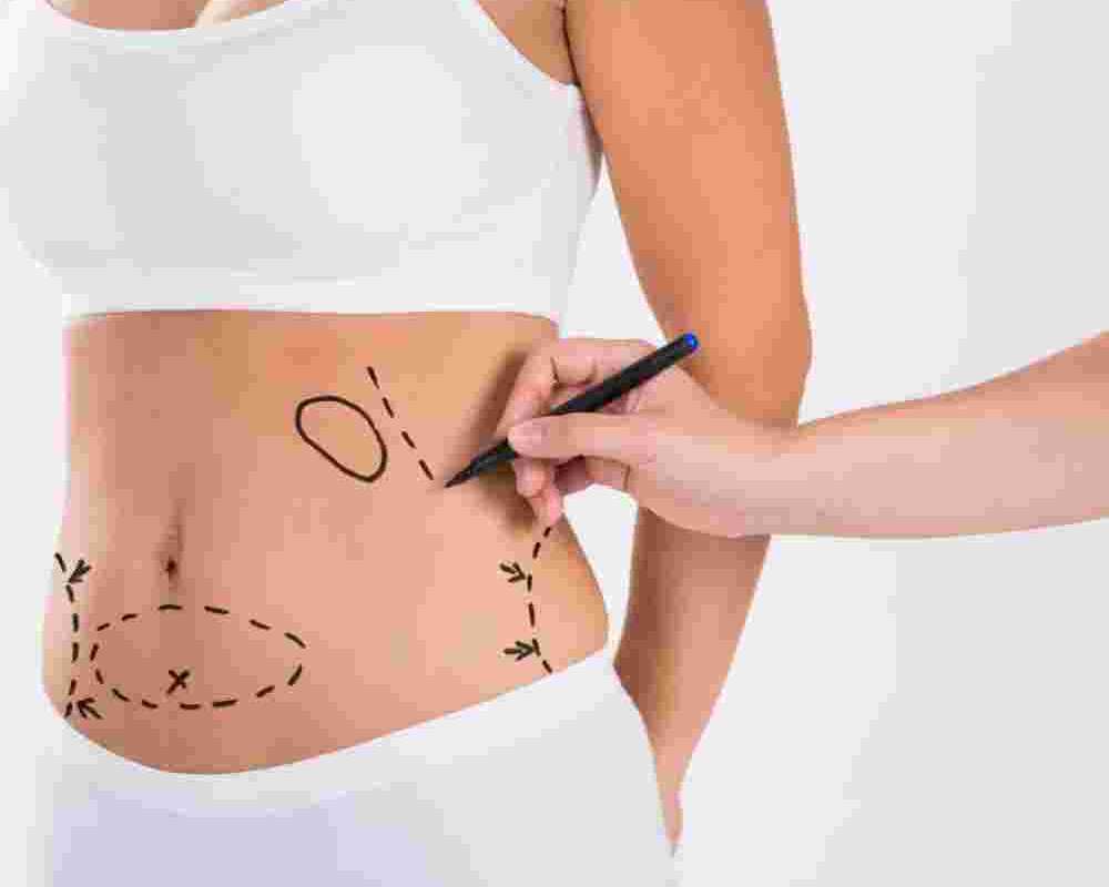 liposuction-surgery-in-andheri-remove-stubborn-fat-effectively