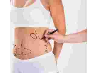 liposuction-surgery-in-andheri-remove-stubborn-fat-effectively-small-0