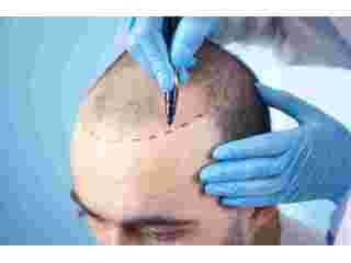 chandra-hair-clinic-leading-fue-hair-transplant-solutions-small-0