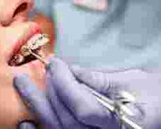 best-braces-in-dombivli-for-a-perfect-smile