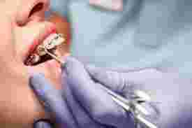 best-braces-in-dombivli-for-a-perfect-smile-big-0