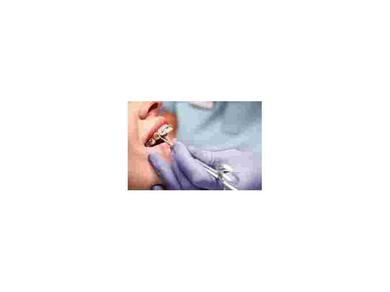 best-braces-in-dombivli-for-a-perfect-smile-small-0