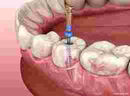 restore-your-smile-with-the-best-root-canal-treatment-in-chetla-big-0