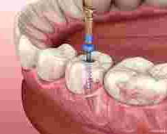 restore-your-smile-with-the-best-root-canal-treatment-in-chetla