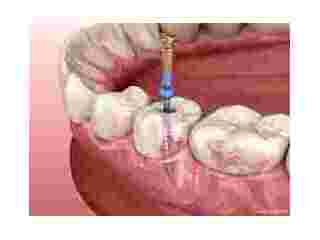 restore-your-smile-with-the-best-root-canal-treatment-in-chetla-small-0